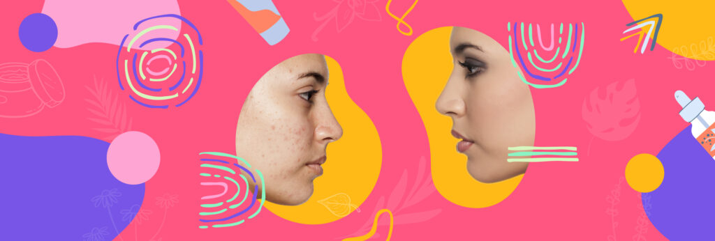 Ilustración con dos mujeres mirándose frente a frente. Una tiene acné visible y la otra tiene acné cubierto con maquillaje porque usó maquillaje para piel con acné.